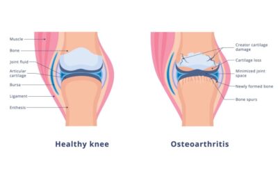 Inflammation and Prolotherapy in Osteoarthritis
