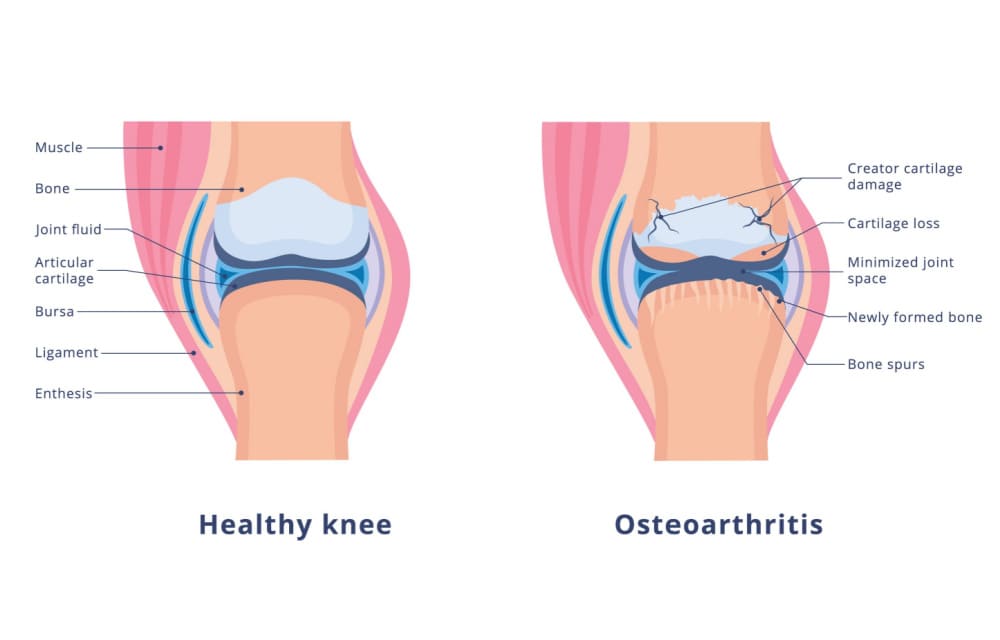 Banner with detailed medical human anatomy with knee osteoarthritis and normal healthy joint.