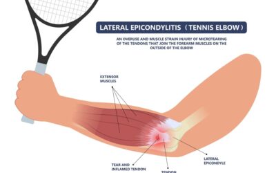 Prolotherapy in the Treatment of “Tennis Elbow” or Lateral Epicondylalgia